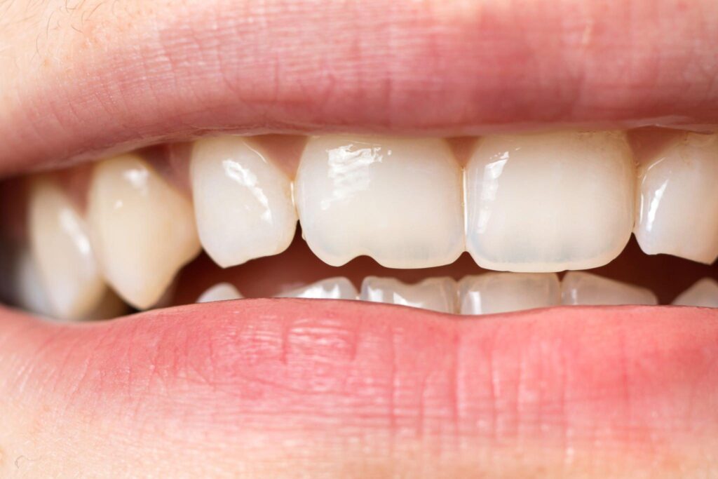 Implications of Chipped Teeth