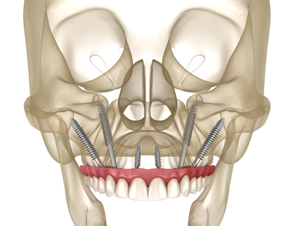 Zygomatic implants