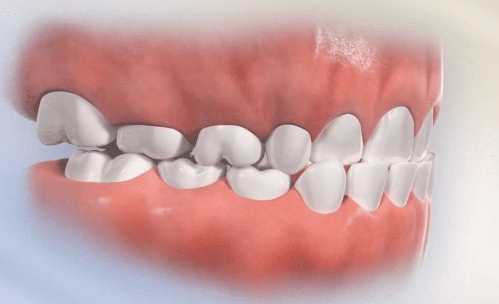 Anterior (Front) Crossbite