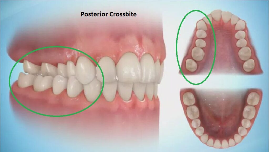 Posterior (Back) Crossbite