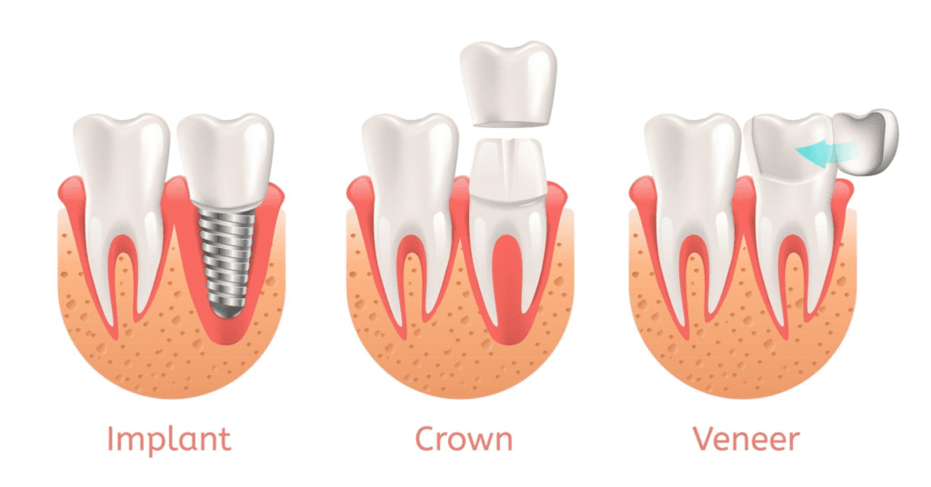 Crowns vs Veneers