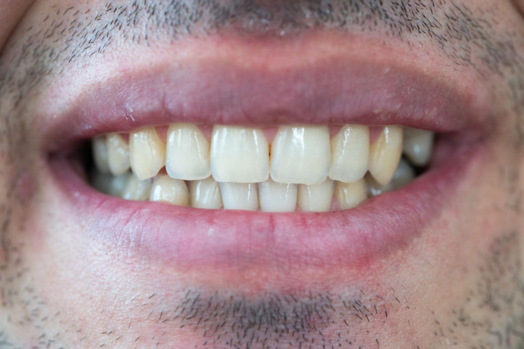 front tooth crowns