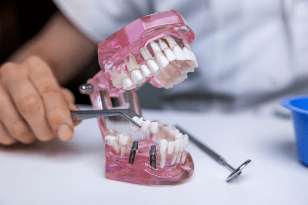 dental bridges