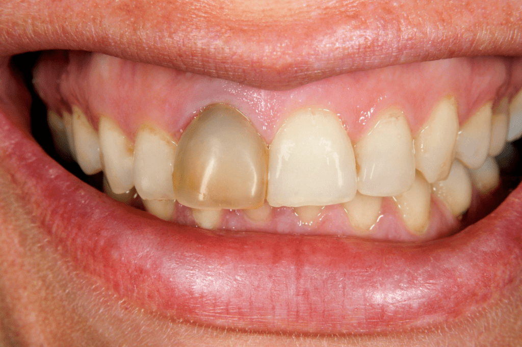 Tooth Discoloration