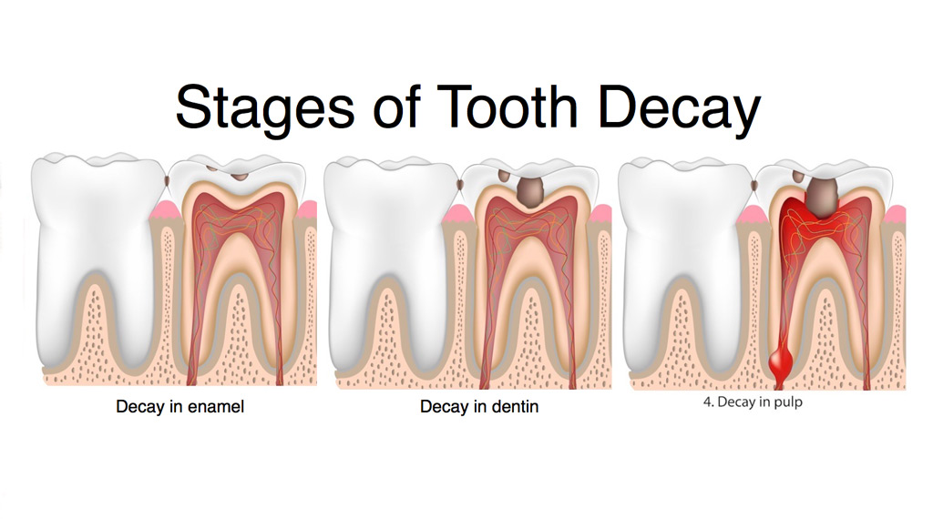 Tooth Decay Stages