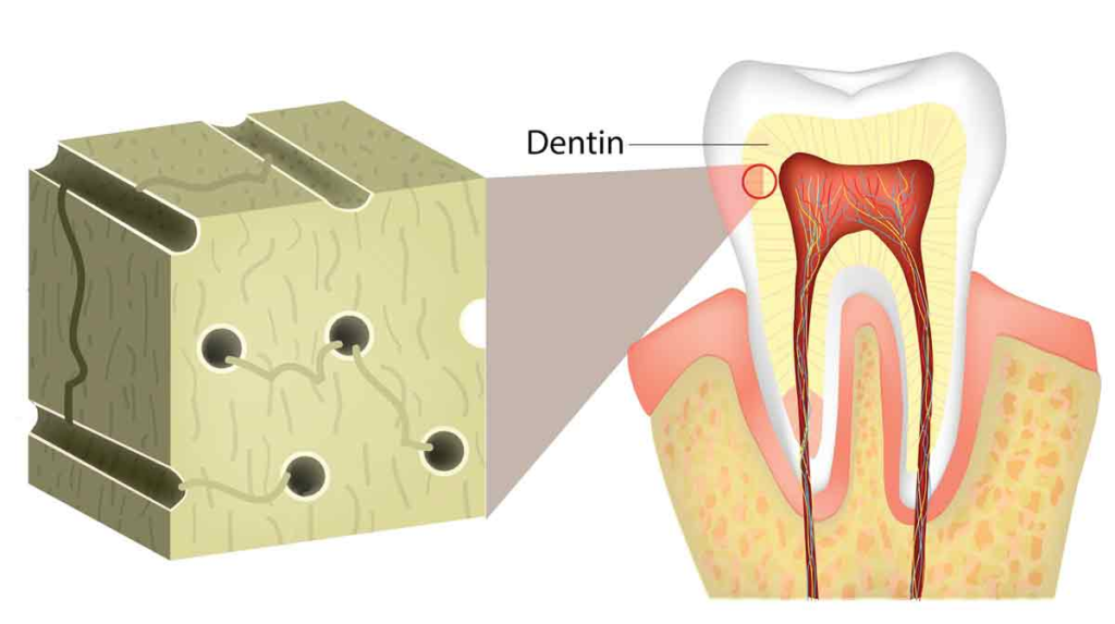 Dentin Decay