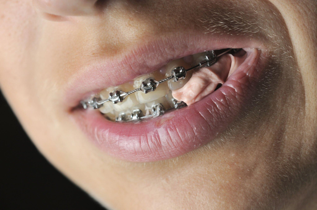 Gum and braces