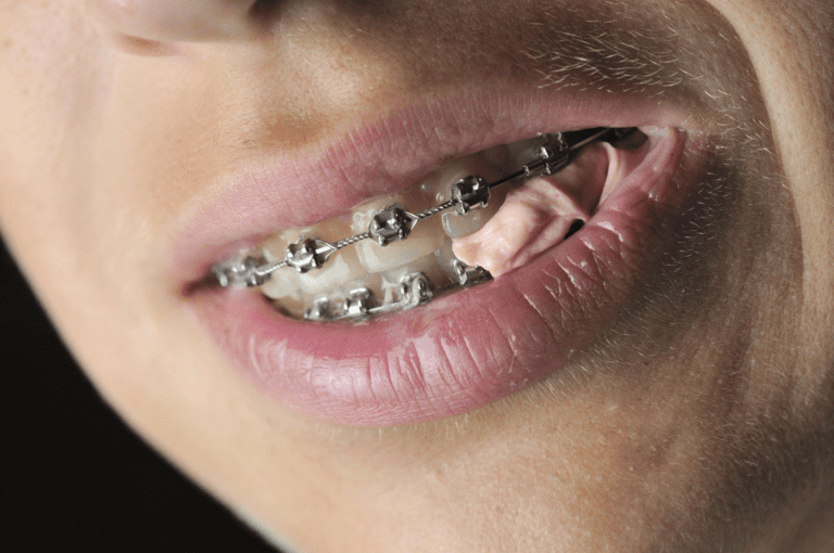 Can You Chew Gum with Braces? ADAApproved SugarFree Options Explained