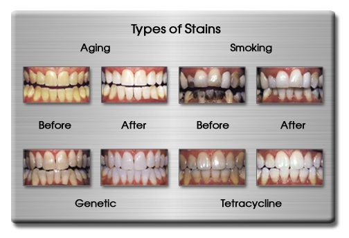 Types of Tooth Stains