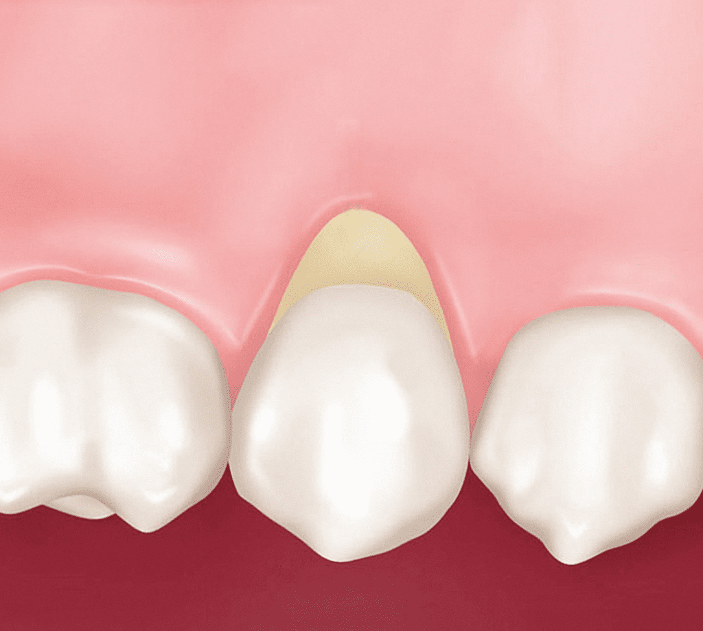 exposed teeth roots