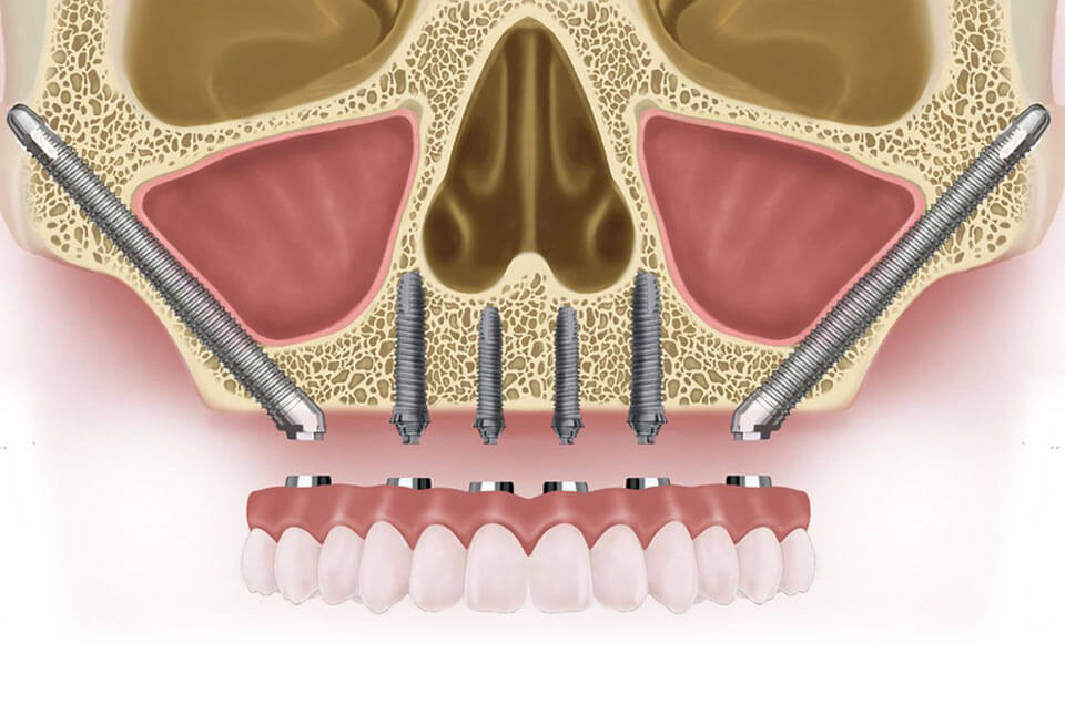 Zygomatic Implants