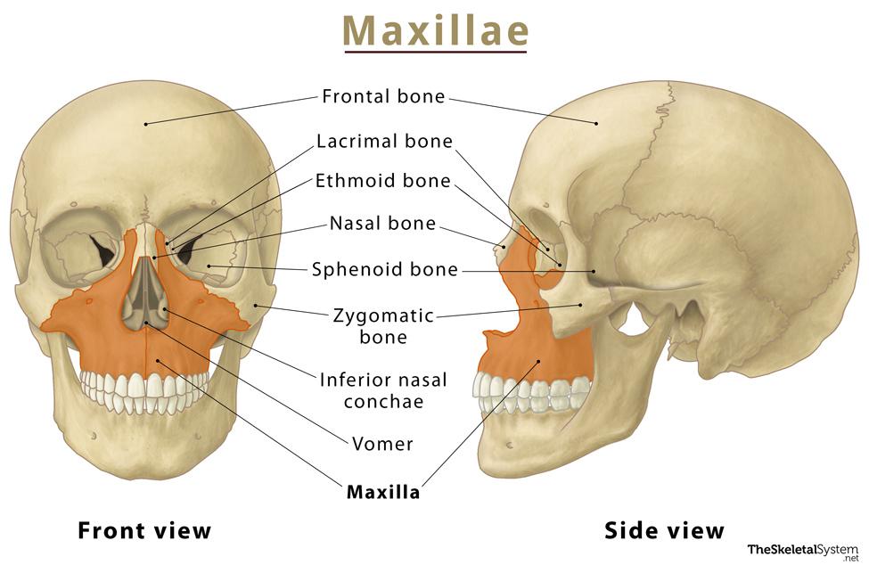 Severe Bone Loss in the Maxilla