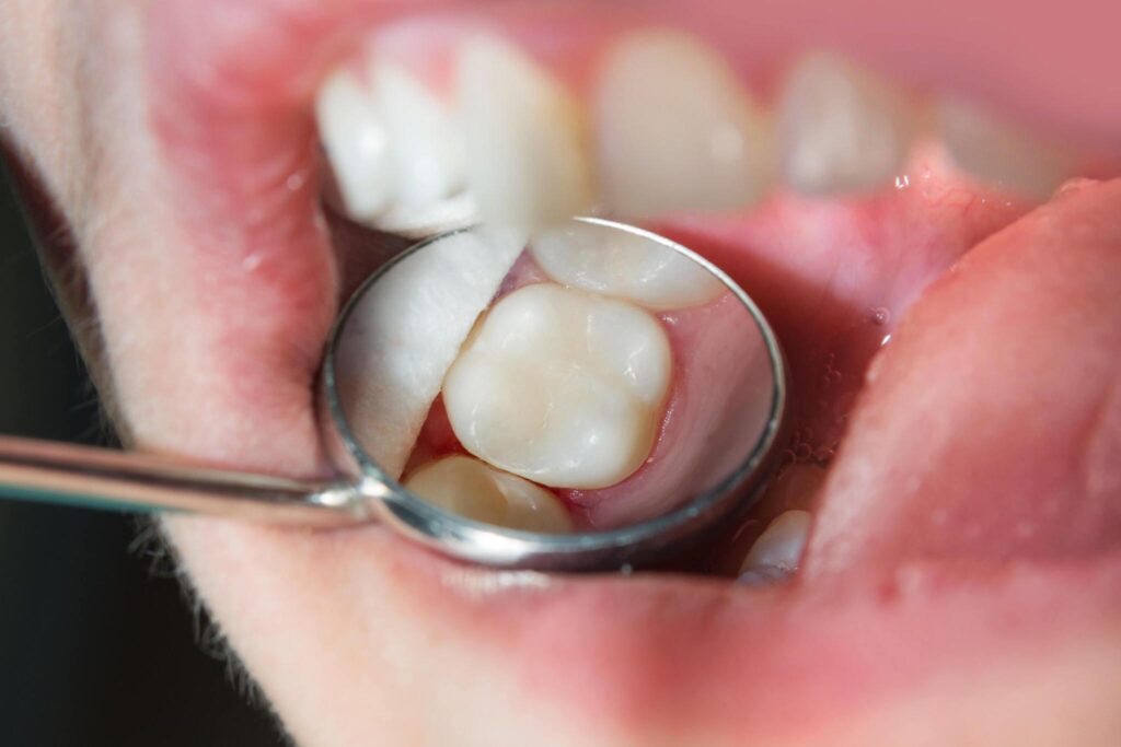 composite fillings affect