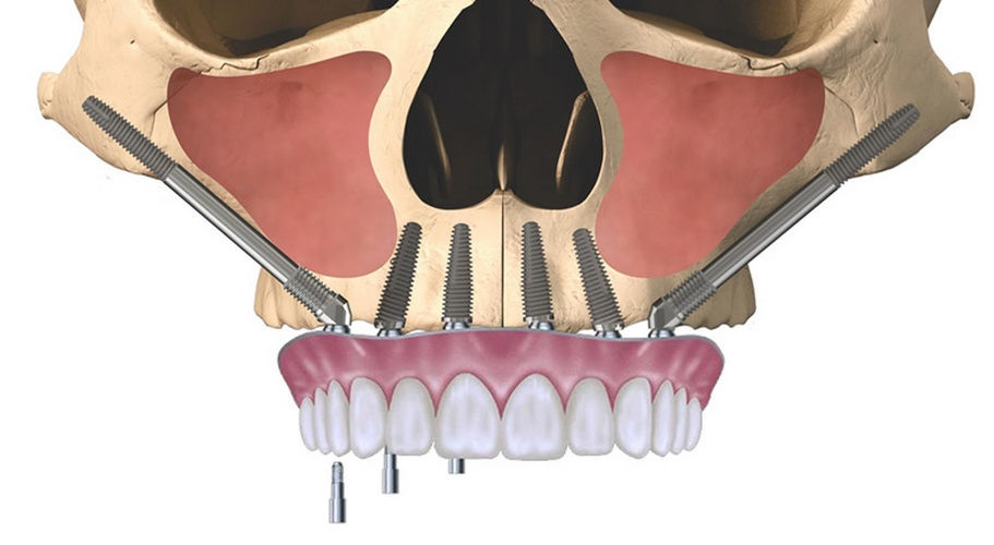 Zygomatic Implant Placement Process