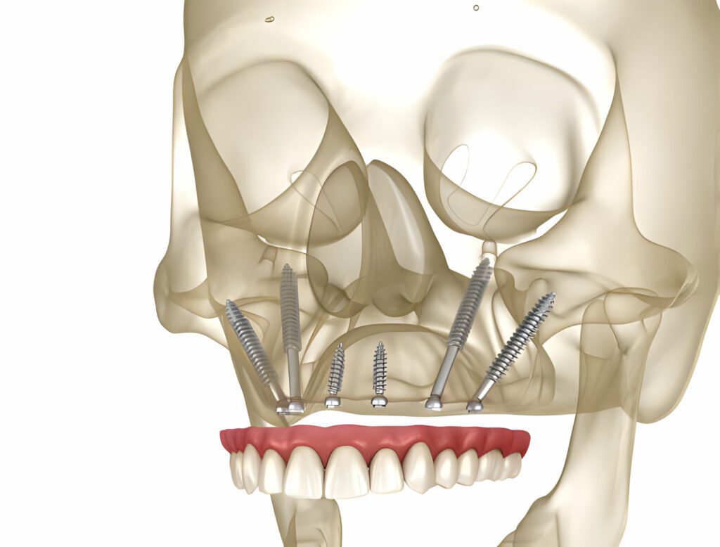 zygomatic implants near me