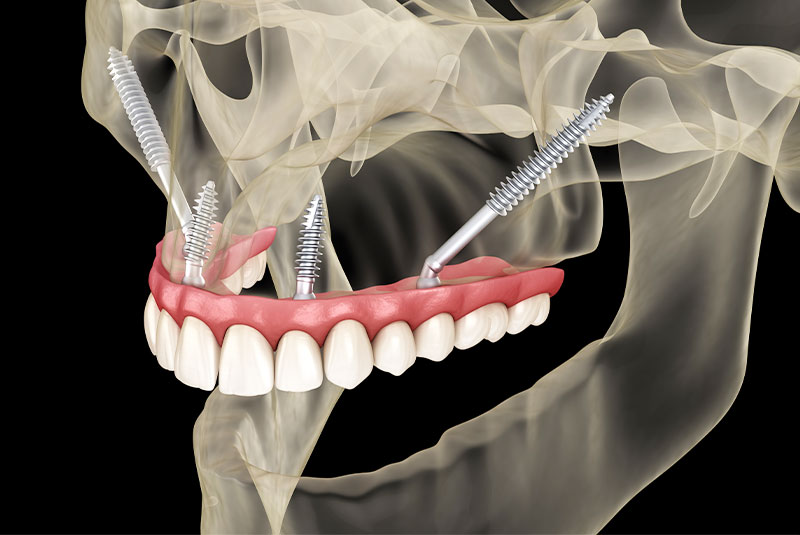 Zygomatic Implants