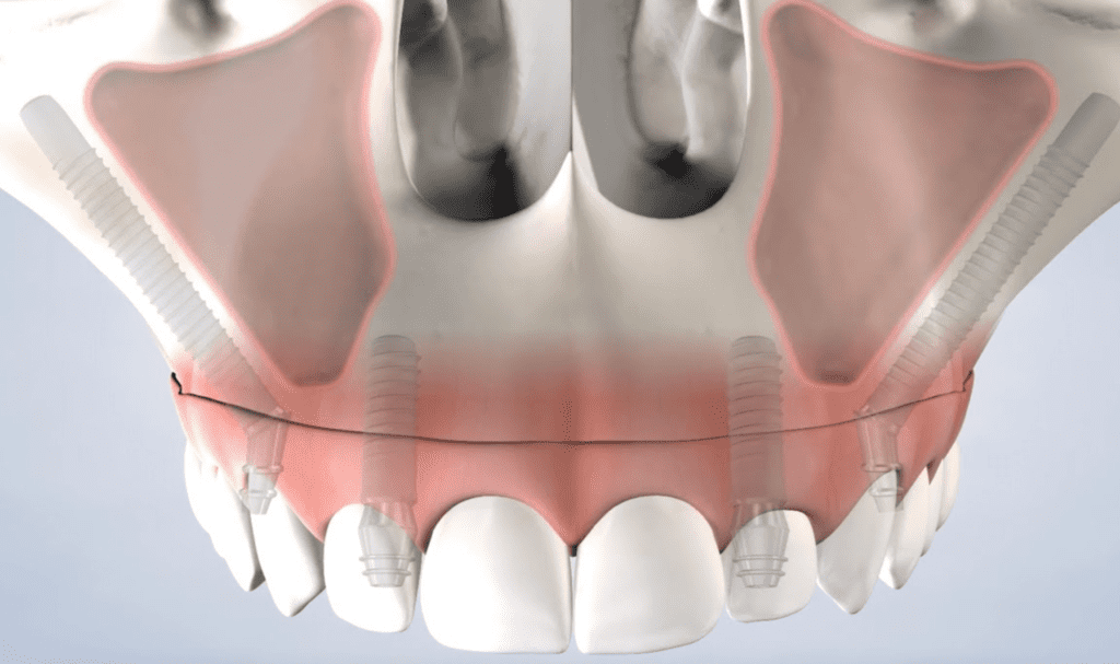 Benefits of Zygomatic Implants