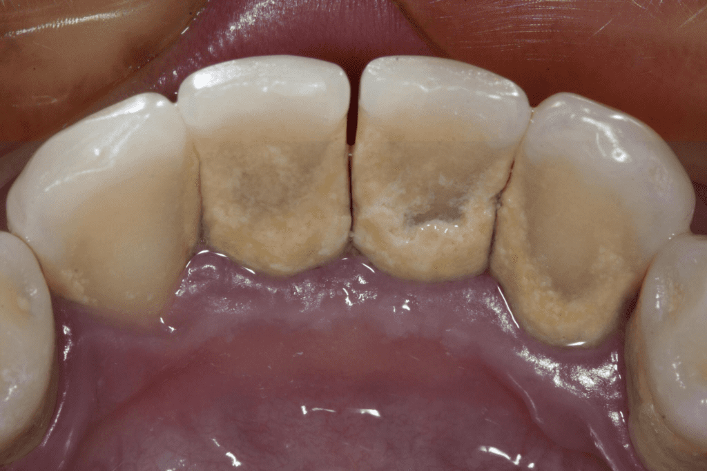 dental plaque